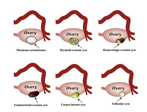 Ovarian cysts .